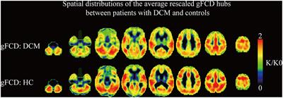 Brain Structural and Functional Dissociated Patterns in Degenerative Cervical Myelopathy: A Case-Controlled Retrospective Resting-State fMRI Study